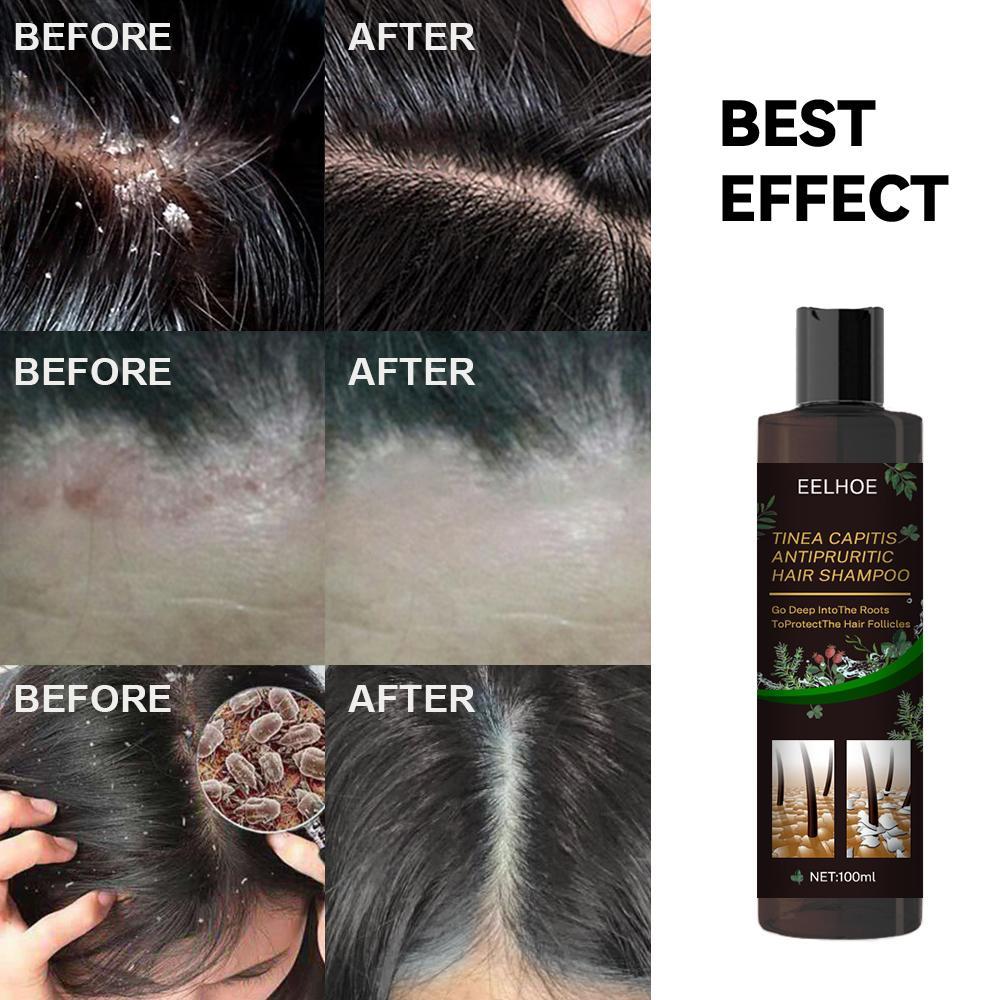 EELHOE Anti-Dandruff Shampoo - Itch Relief, Hair Loss Prevention, Oil Control & Refreshing Care